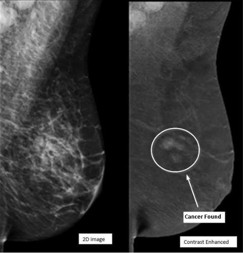 Contrast-Enhanced Mammography (CEM)